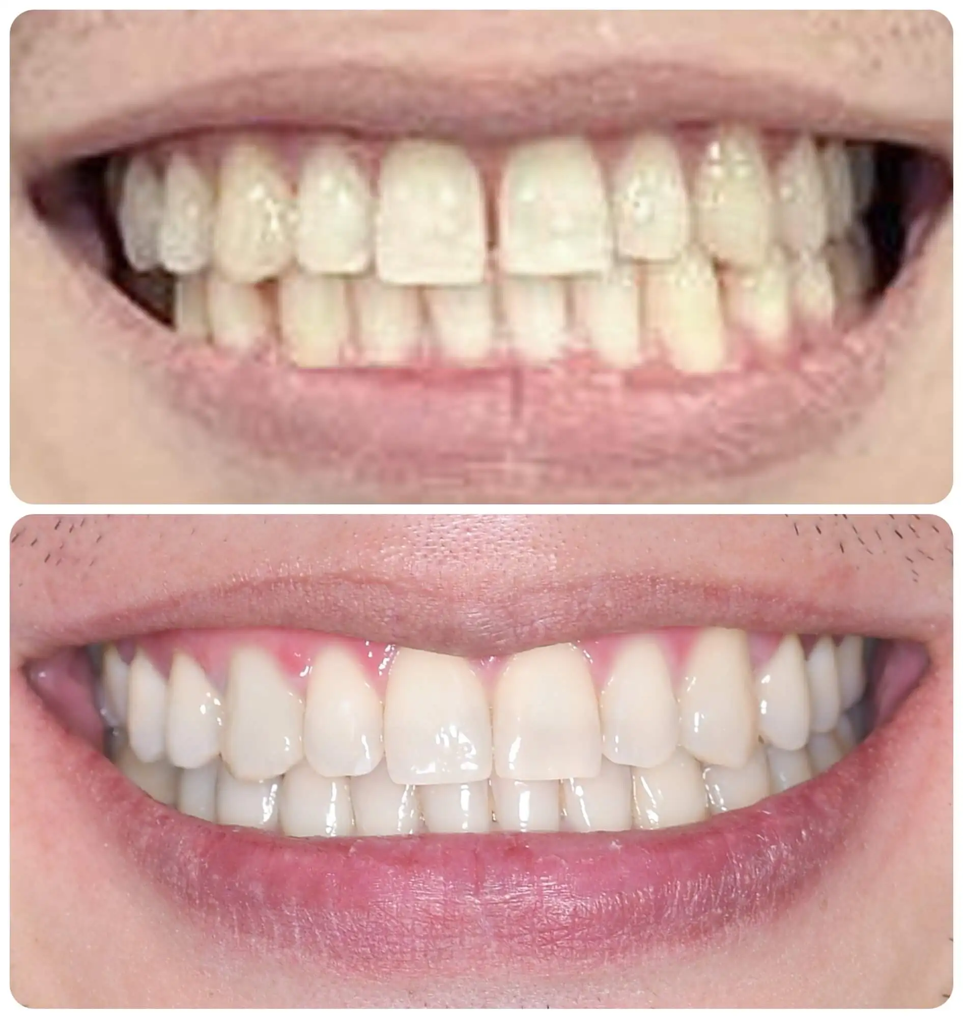 invisible aligners Dubai