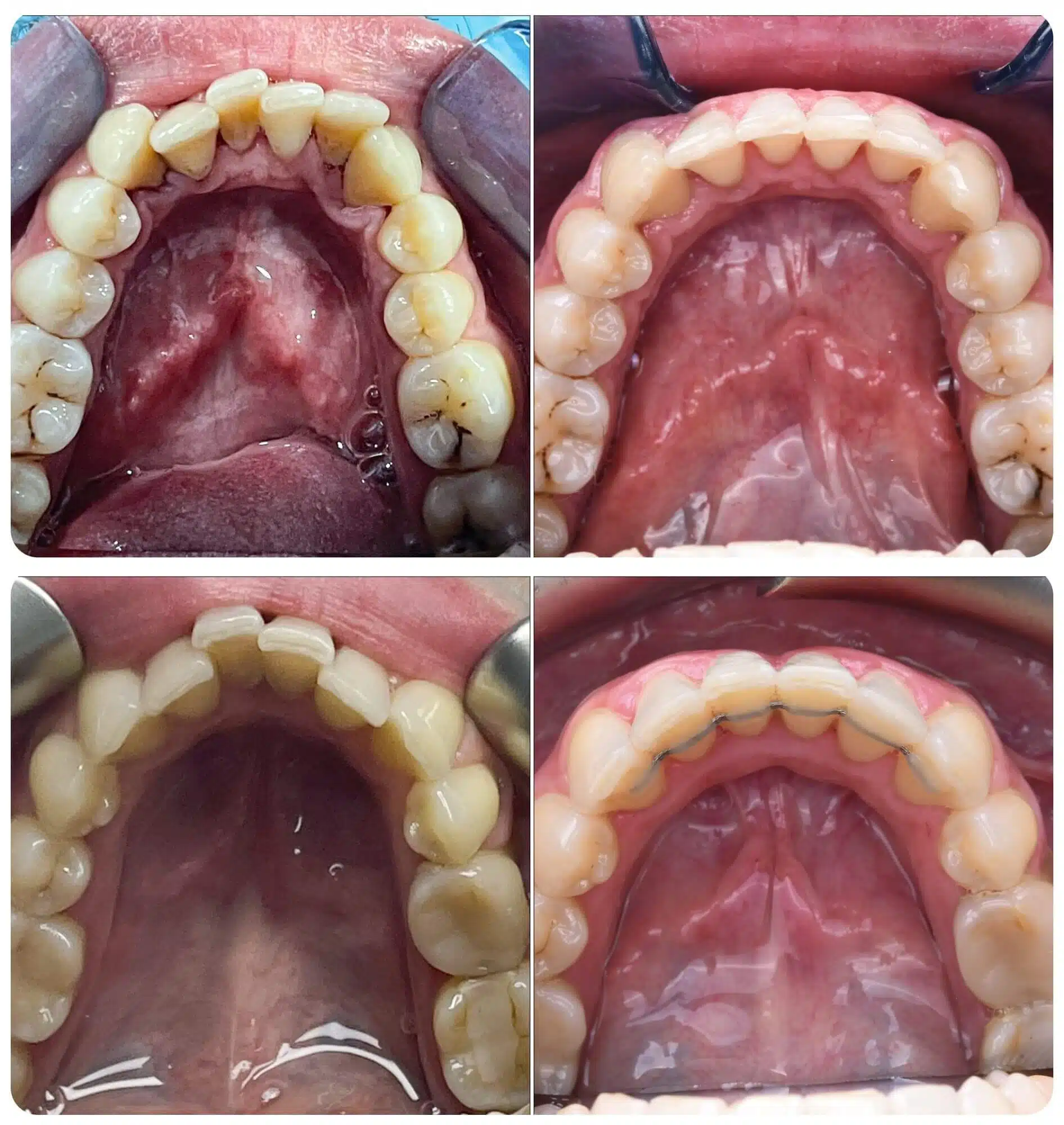 Clear aligners in Dubai