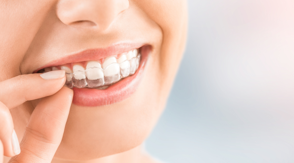 clear aligners vs braces