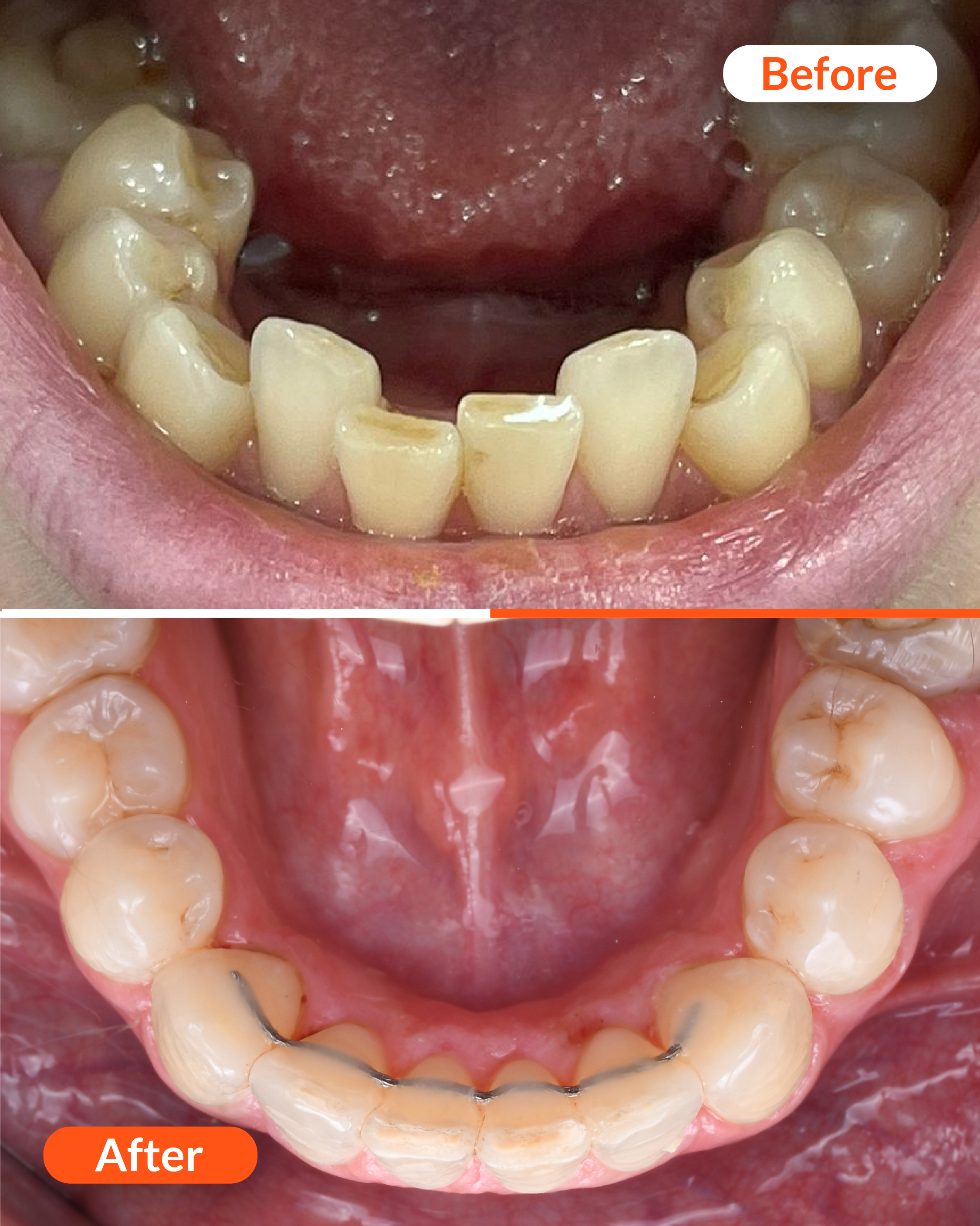 Before and After clear aligners