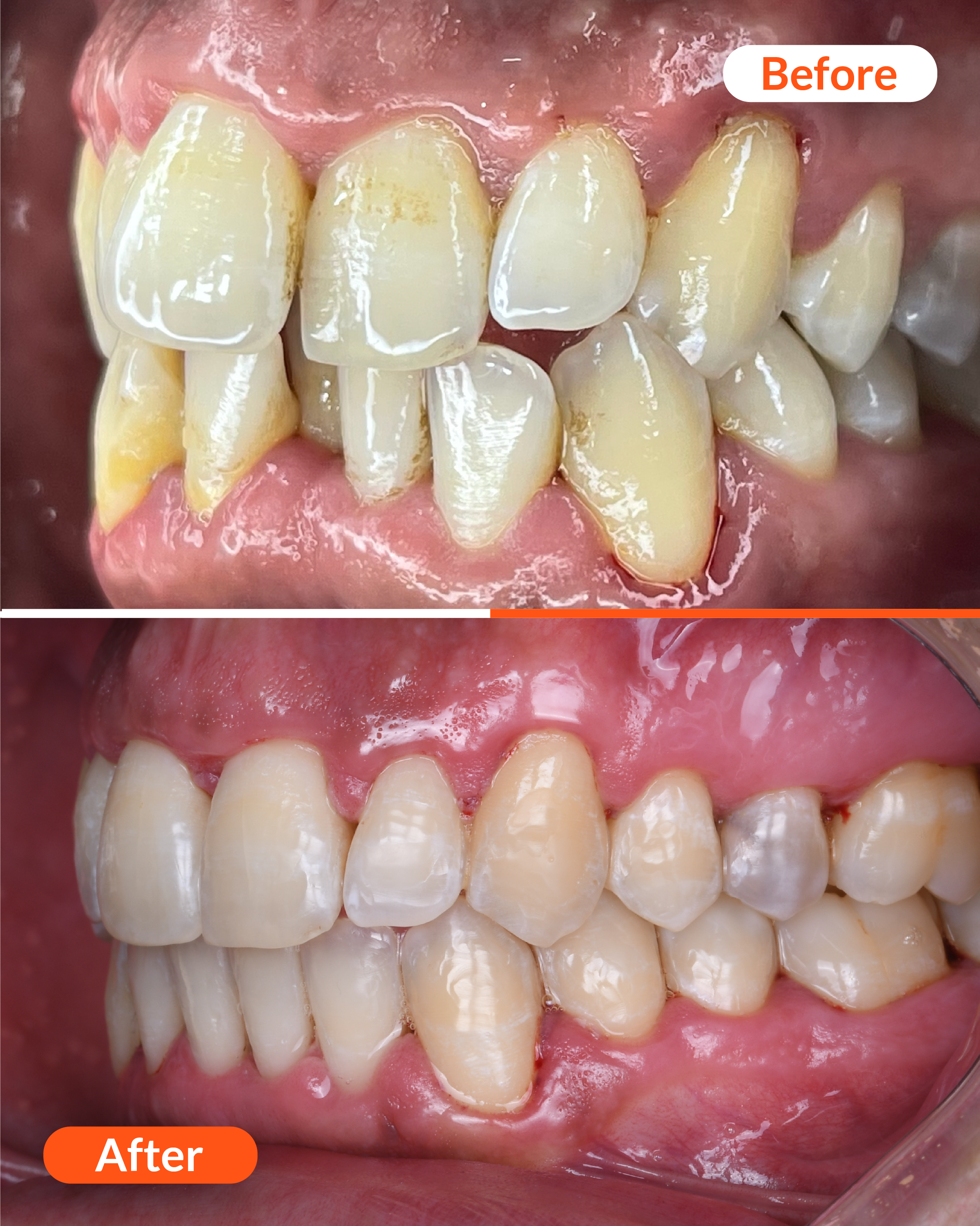 Clear Aligner treatmen Proalign Clinic Before and After